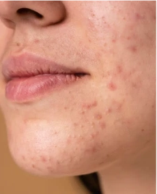 نمونه کار اندولیفت بدن و لیفتینگ پوست