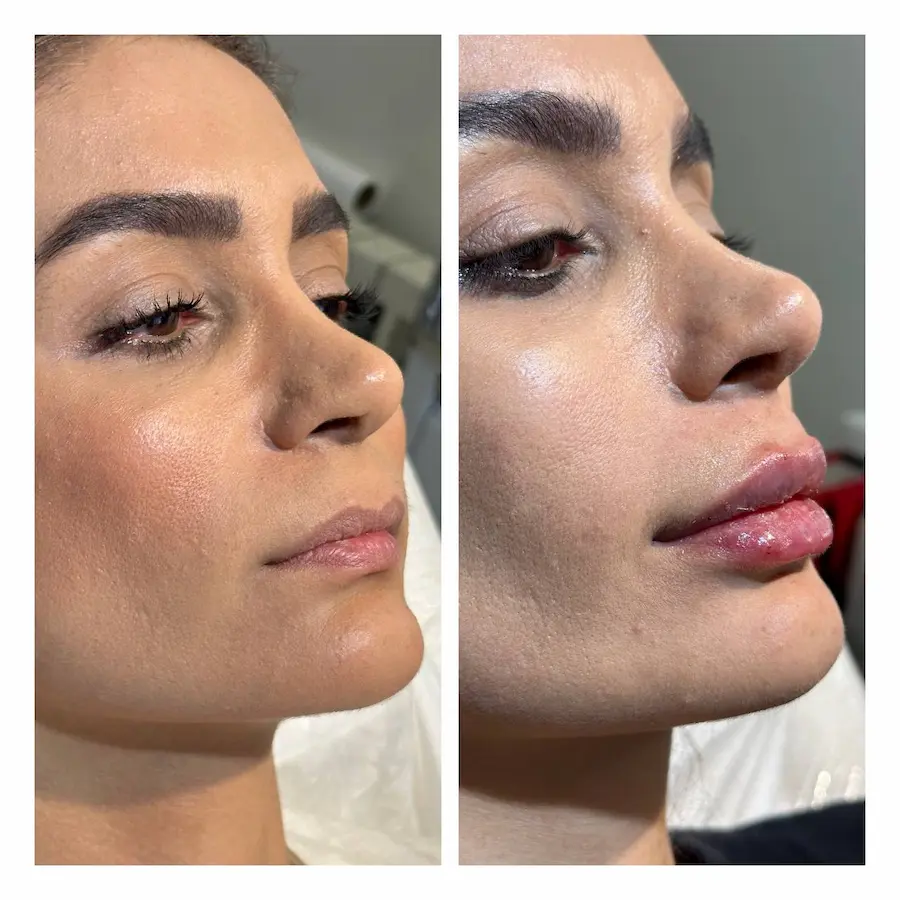 نمونه کار 2 - اندولیفت بدن و لیفتینگ