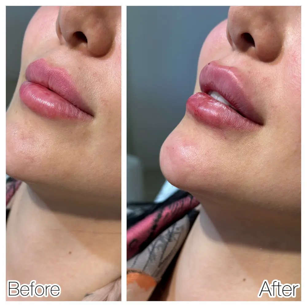 نمونه کار 3 - تزریق بوتاکس و فیلر لب