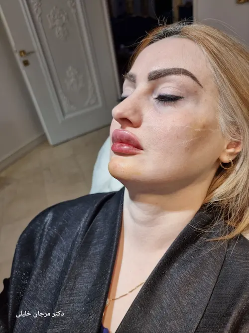 نمونه کار 1 - جوانسازی پوست صورت