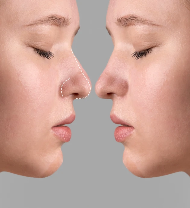 پیش و پس از لیزر موهای زائد